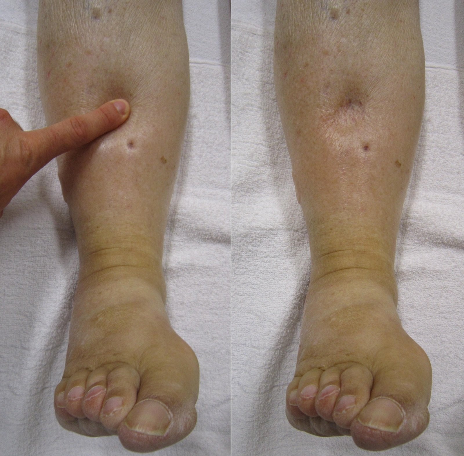 A finger pressing into swollen skin on a lower leg, leaving a temporary indentation — a test used to identify fluid retention